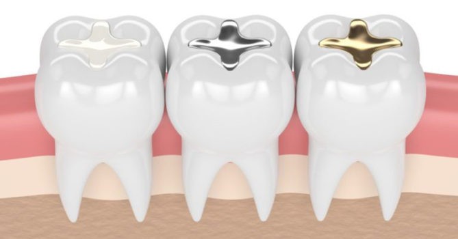 Let’s talk about something almost every adult may encounter – dental fillings!
