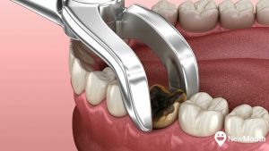 Read more about the article Tooth Extractions