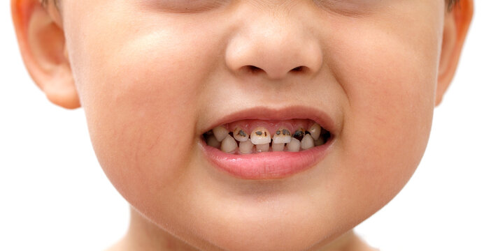 Read more about the article Hidden Threats: How Cavities Can Develop Without Any Warning Signs